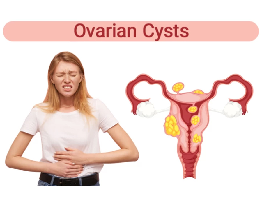 Ovarian Cysts? Let Your Diet do the Work!